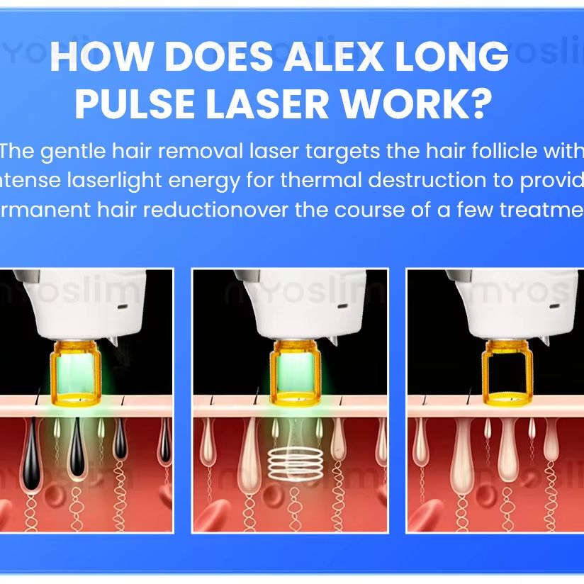 Hair Care In Salon - 755nm Alexandrite Long Pulse Lase Salon