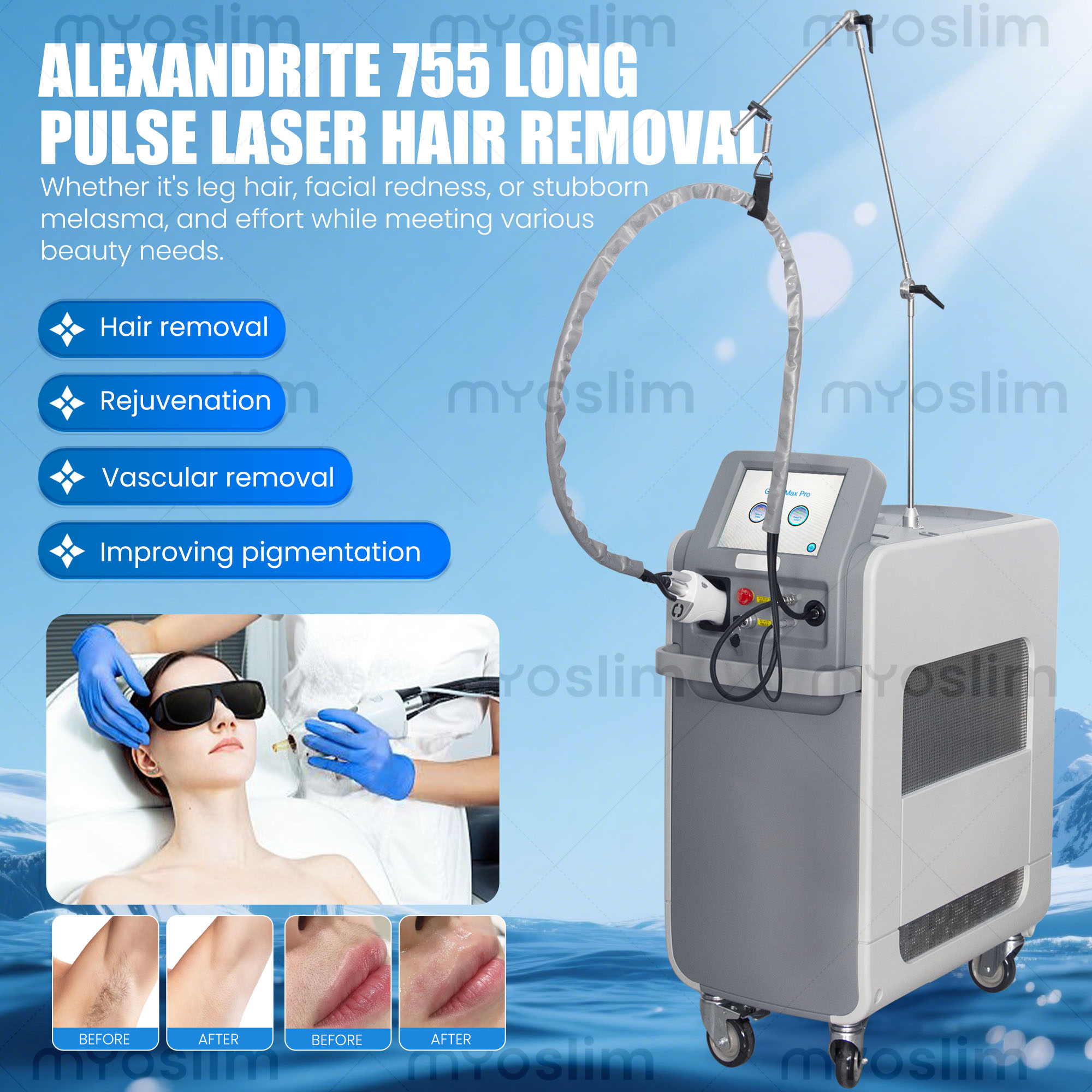 755nm Alexandrite Long Pulse L - Hair Care In Salon ulasan dan harga